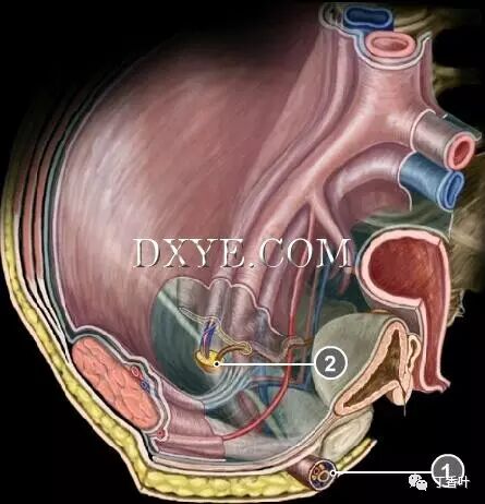 疝气补片怎么固定双层补片修补腹股沟疝（图文演示）_https://www.jmylbn.com_新闻资讯_第4张