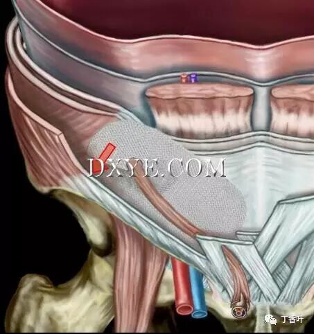 疝气补片怎么固定双层补片修补腹股沟疝（图文演示）_https://www.jmylbn.com_新闻资讯_第77张