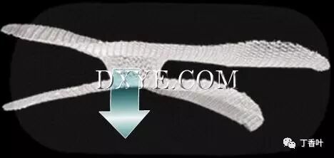 疝气补片怎么固定双层补片修补腹股沟疝（图文演示）_https://www.jmylbn.com_新闻资讯_第71张