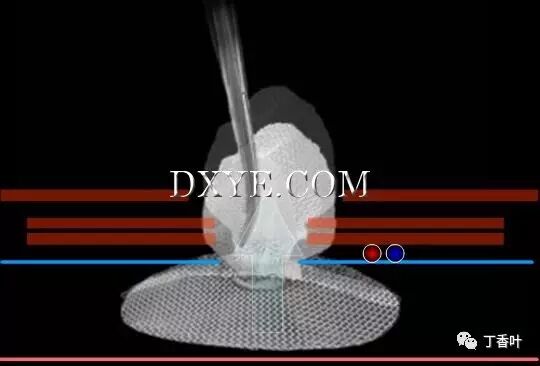 疝气补片怎么固定双层补片修补腹股沟疝（图文演示）_https://www.jmylbn.com_新闻资讯_第67张