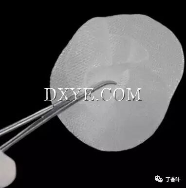 疝气补片怎么固定双层补片修补腹股沟疝（图文演示）_https://www.jmylbn.com_新闻资讯_第63张