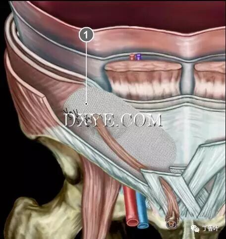 疝气补片怎么固定双层补片修补腹股沟疝（图文演示）_https://www.jmylbn.com_新闻资讯_第78张