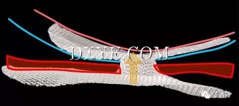 疝气补片怎么固定双层补片修补腹股沟疝（图文演示）_https://www.jmylbn.com_新闻资讯_第58张