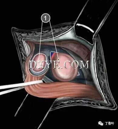 疝气补片怎么固定双层补片修补腹股沟疝（图文演示）_https://www.jmylbn.com_新闻资讯_第48张
