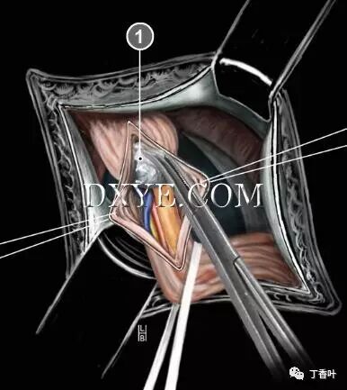 疝气补片怎么固定双层补片修补腹股沟疝（图文演示）_https://www.jmylbn.com_新闻资讯_第45张