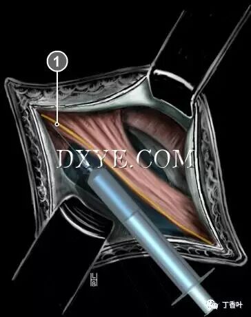 疝气补片怎么固定双层补片修补腹股沟疝（图文演示）_https://www.jmylbn.com_新闻资讯_第21张