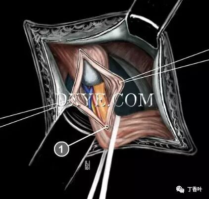疝气补片怎么固定双层补片修补腹股沟疝（图文演示）_https://www.jmylbn.com_新闻资讯_第34张
