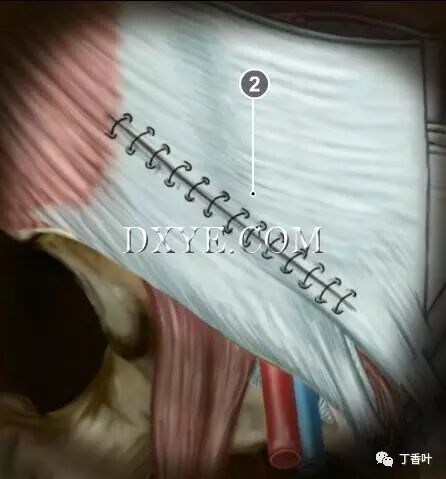 疝气补片怎么固定双层补片修补腹股沟疝（图文演示）_https://www.jmylbn.com_新闻资讯_第81张