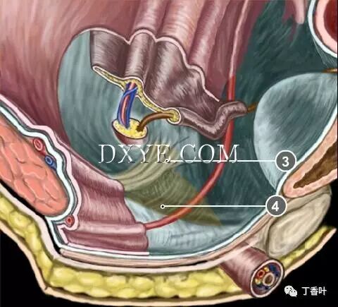 疝气补片怎么固定双层补片修补腹股沟疝（图文演示）_https://www.jmylbn.com_新闻资讯_第5张