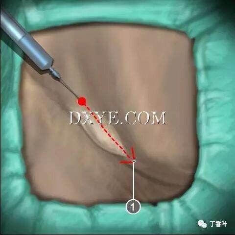 疝气补片怎么固定双层补片修补腹股沟疝（图文演示）_https://www.jmylbn.com_新闻资讯_第17张