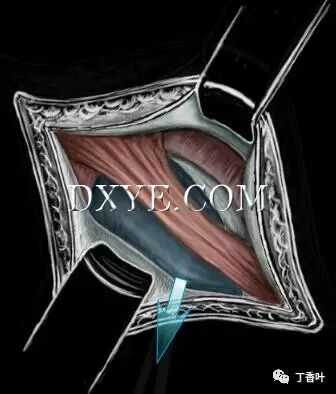 疝气补片怎么固定双层补片修补腹股沟疝（图文演示）_https://www.jmylbn.com_新闻资讯_第29张