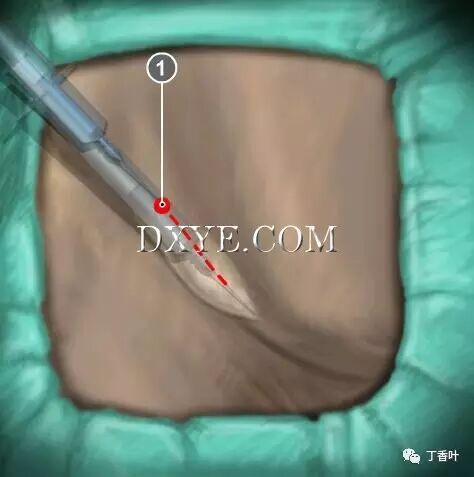 疝气补片怎么固定双层补片修补腹股沟疝（图文演示）_https://www.jmylbn.com_新闻资讯_第23张