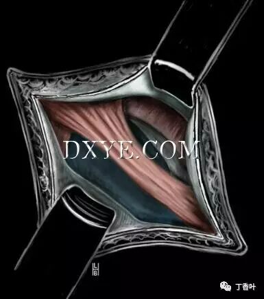 疝气补片怎么固定双层补片修补腹股沟疝（图文演示）_https://www.jmylbn.com_新闻资讯_第27张