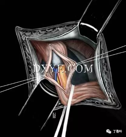 疝气补片怎么固定双层补片修补腹股沟疝（图文演示）_https://www.jmylbn.com_新闻资讯_第41张
