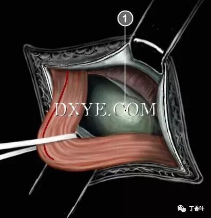 疝气补片怎么固定双层补片修补腹股沟疝（图文演示）_https://www.jmylbn.com_新闻资讯_第36张