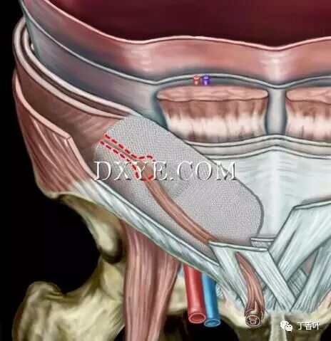 疝气补片怎么固定双层补片修补腹股沟疝（图文演示）_https://www.jmylbn.com_新闻资讯_第74张