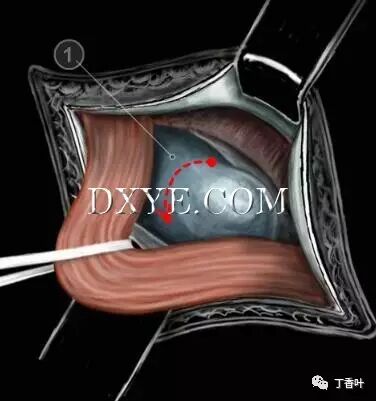 疝气补片怎么固定双层补片修补腹股沟疝（图文演示）_https://www.jmylbn.com_新闻资讯_第46张