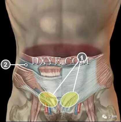 疝气补片怎么固定双层补片修补腹股沟疝（图文演示）_https://www.jmylbn.com_新闻资讯_第2张