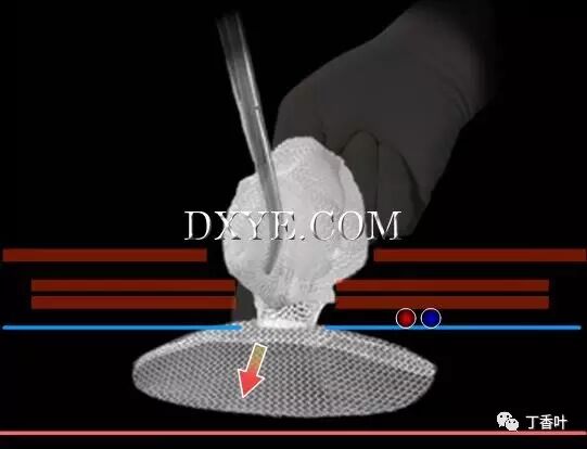 疝气补片怎么固定双层补片修补腹股沟疝（图文演示）_https://www.jmylbn.com_新闻资讯_第68张