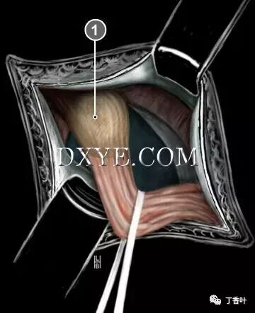 疝气补片怎么固定双层补片修补腹股沟疝（图文演示）_https://www.jmylbn.com_新闻资讯_第32张