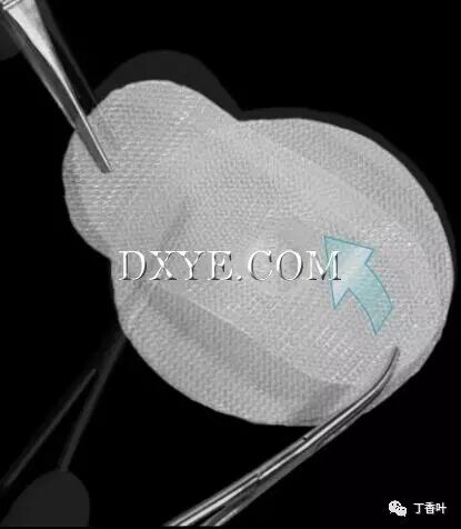 疝气补片怎么固定双层补片修补腹股沟疝（图文演示）_https://www.jmylbn.com_新闻资讯_第62张