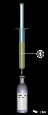 疝气补片怎么固定双层补片修补腹股沟疝（图文演示）_https://www.jmylbn.com_新闻资讯_第16张
