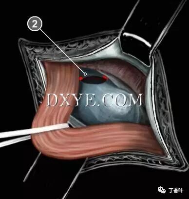 疝气补片怎么固定双层补片修补腹股沟疝（图文演示）_https://www.jmylbn.com_新闻资讯_第47张