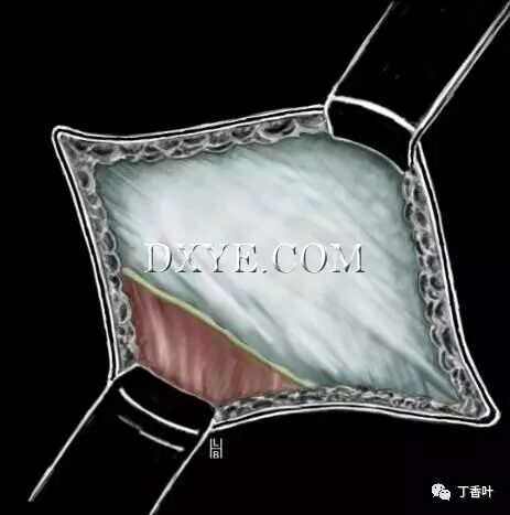 疝气补片怎么固定双层补片修补腹股沟疝（图文演示）_https://www.jmylbn.com_新闻资讯_第25张