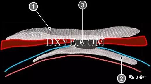 疝气补片怎么固定双层补片修补腹股沟疝（图文演示）_https://www.jmylbn.com_新闻资讯_第13张