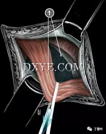疝气补片怎么固定双层补片修补腹股沟疝（图文演示）_https://www.jmylbn.com_新闻资讯_第30张