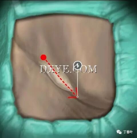 疝气补片怎么固定双层补片修补腹股沟疝（图文演示）_https://www.jmylbn.com_新闻资讯_第18张