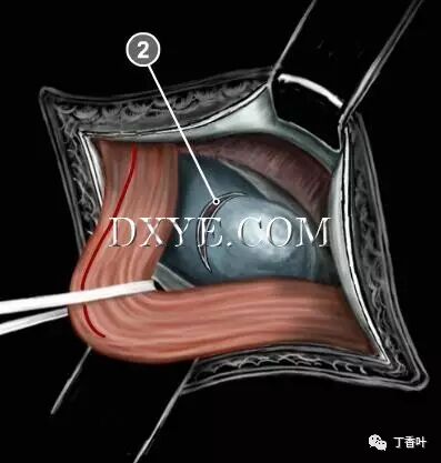 疝气补片怎么固定双层补片修补腹股沟疝（图文演示）_https://www.jmylbn.com_新闻资讯_第37张