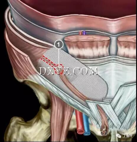 疝气补片怎么固定双层补片修补腹股沟疝（图文演示）_https://www.jmylbn.com_新闻资讯_第75张