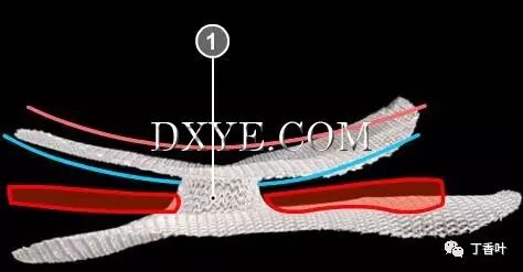 疝气补片怎么固定双层补片修补腹股沟疝（图文演示）_https://www.jmylbn.com_新闻资讯_第55张