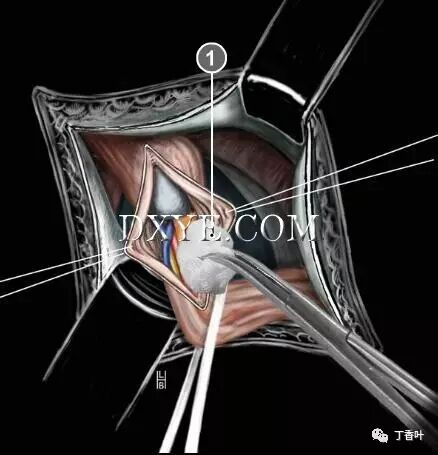 疝气补片怎么固定双层补片修补腹股沟疝（图文演示）_https://www.jmylbn.com_新闻资讯_第42张