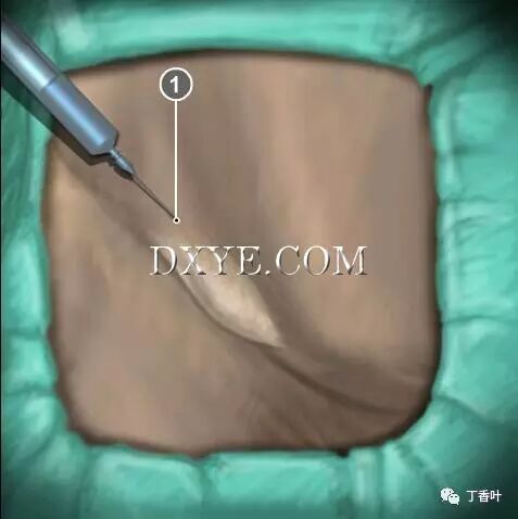 疝气补片怎么固定双层补片修补腹股沟疝（图文演示）_https://www.jmylbn.com_新闻资讯_第22张