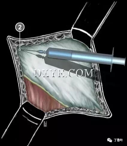疝气补片怎么固定双层补片修补腹股沟疝（图文演示）_https://www.jmylbn.com_新闻资讯_第19张