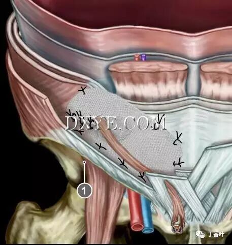 疝气补片怎么固定双层补片修补腹股沟疝（图文演示）_https://www.jmylbn.com_新闻资讯_第79张
