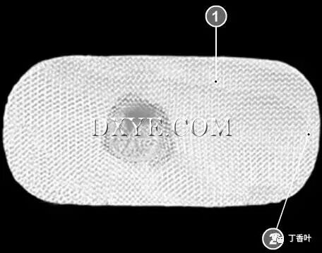 疝气补片怎么固定双层补片修补腹股沟疝（图文演示）_https://www.jmylbn.com_新闻资讯_第72张