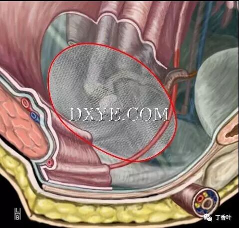 疝气补片怎么固定双层补片修补腹股沟疝（图文演示）_https://www.jmylbn.com_新闻资讯_第54张