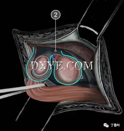 疝气补片怎么固定双层补片修补腹股沟疝（图文演示）_https://www.jmylbn.com_新闻资讯_第39张