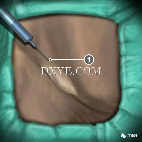 疝气补片怎么固定双层补片修补腹股沟疝（图文演示）_https://www.jmylbn.com_新闻资讯_第15张