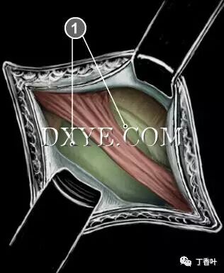 疝气补片怎么固定双层补片修补腹股沟疝（图文演示）_https://www.jmylbn.com_新闻资讯_第28张