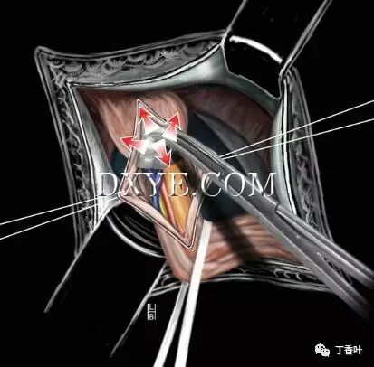 疝气补片怎么固定双层补片修补腹股沟疝（图文演示）_https://www.jmylbn.com_新闻资讯_第44张