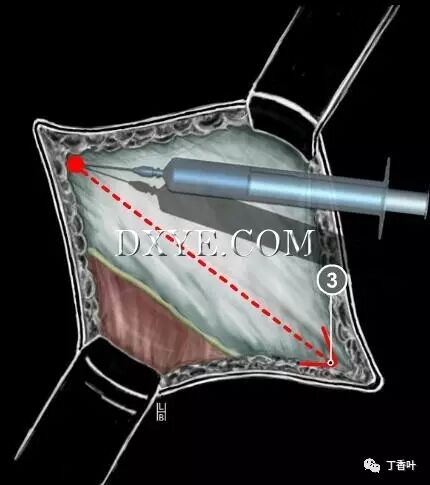 疝气补片怎么固定双层补片修补腹股沟疝（图文演示）_https://www.jmylbn.com_新闻资讯_第20张