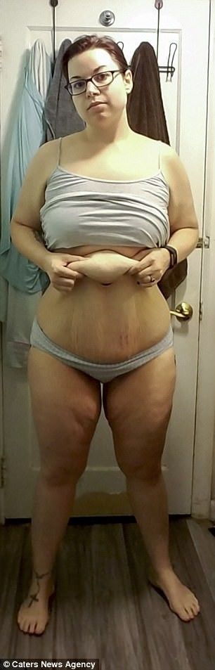 减肥手术后遗症_手术减肥_减肥手术多少钱