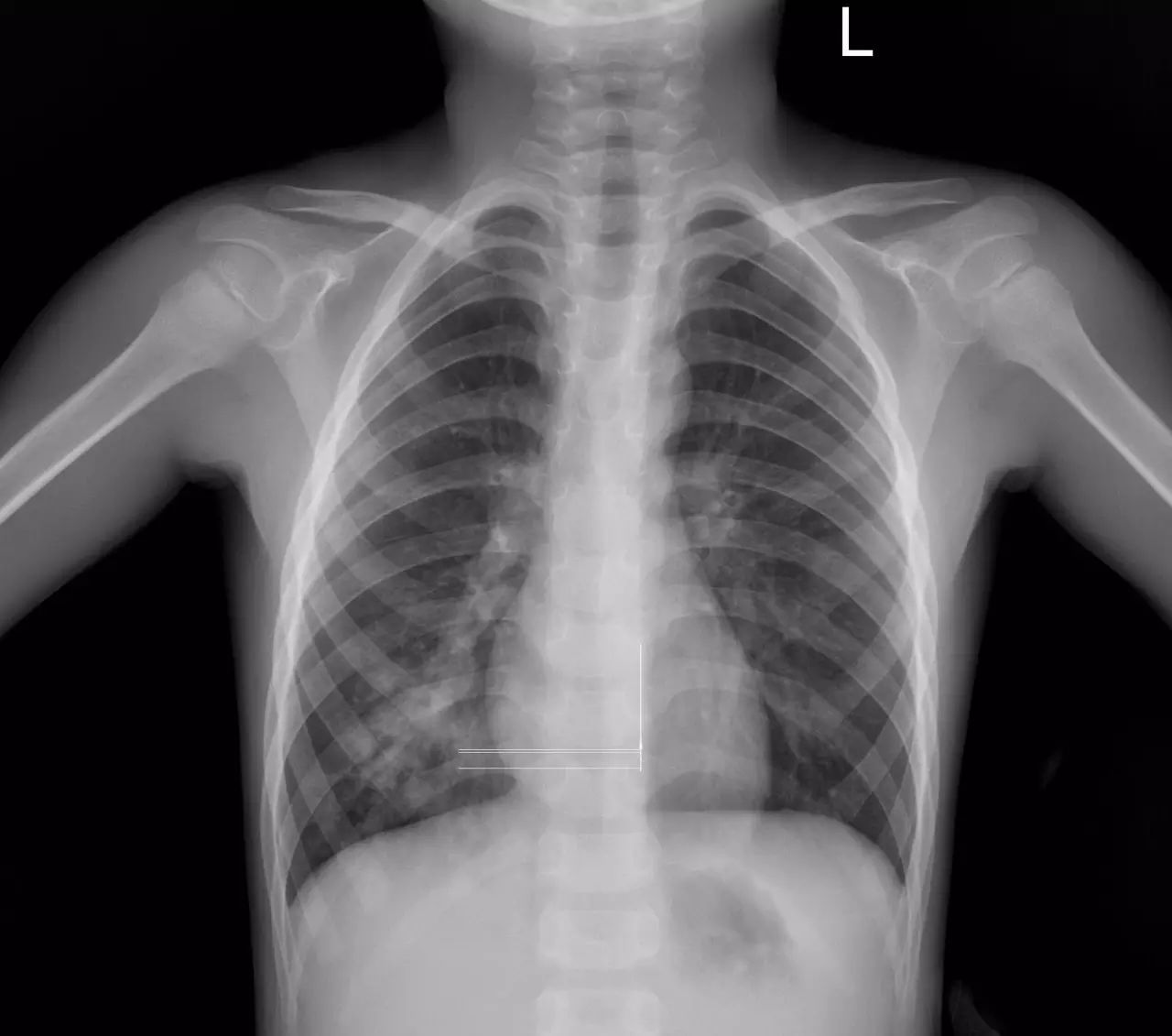 图1胸片显示患者右下肺肺炎