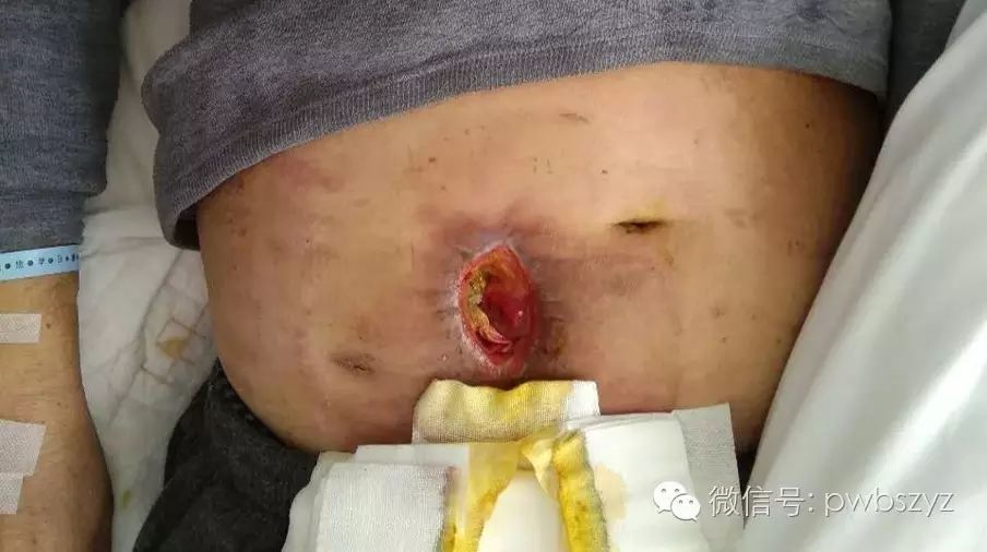 病例2: 男 53岁 阑尾炎术后并发盲肠瘘及下消化道出血,患者1月前行