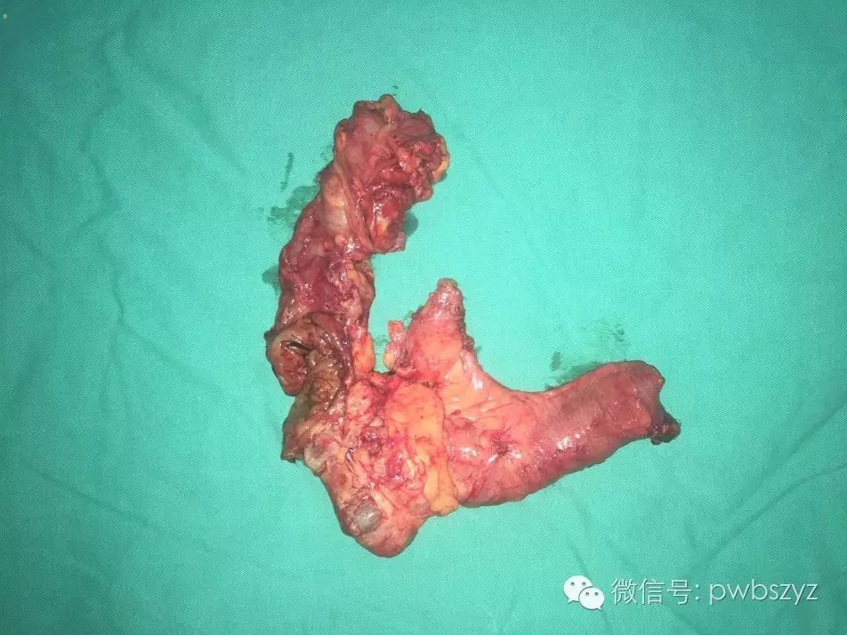 右结肠(盲肠和部分升结肠)移除后的术野,右下腹可见引流管腹腔段