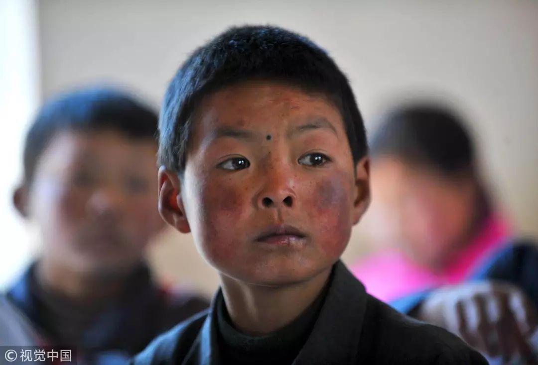 强烈的紫外线将高山上孩子的皮肤灼伤,留下"高原红脸蛋" / 视觉中国